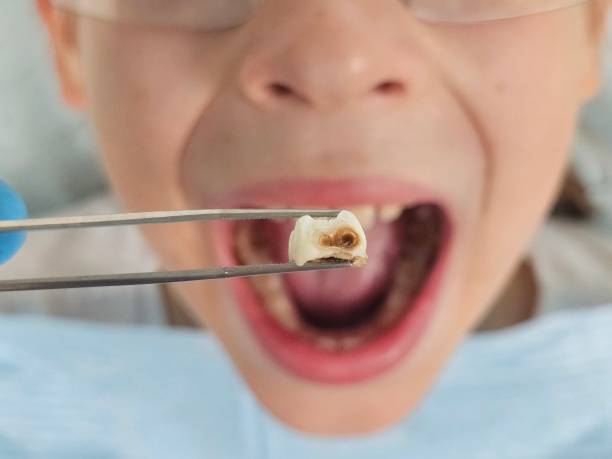 Best Emergency Root Canal Therapy in New Fairview, TX